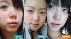 诱发痤疮发生的病因有哪些呢